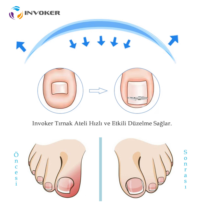 آتل-ناخن-فرورفته-1761913760-4