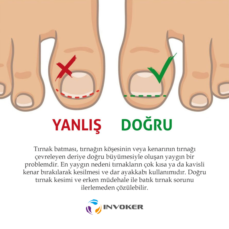 آتل-ناخن-فرورفته-1761913760-7